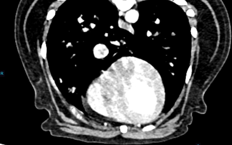 Canine Thorax — Pyogranulomatous pulmonary nodules