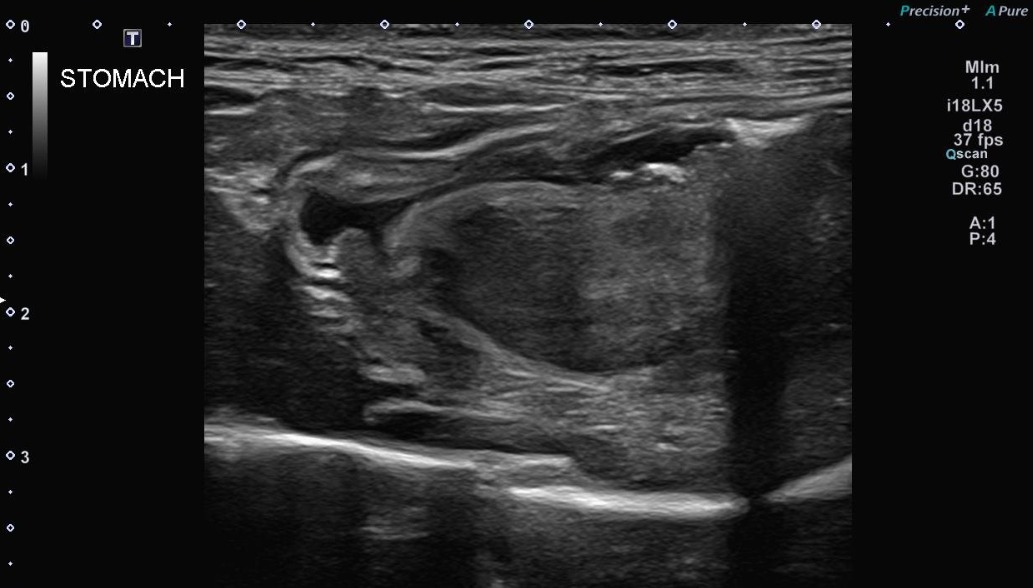 Feline Abdomen, Thorax — Gastric lymphoma, large cell